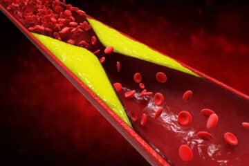 controlar o colesterol 3d rendering atherosclerosis with cholesterol blood or plaque in vessel cause of coronary artery disease